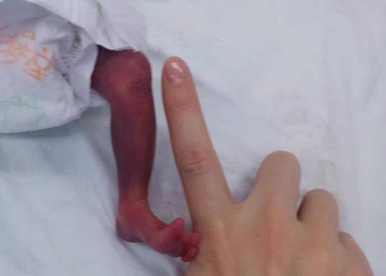 The baby's leg at the time of birth is compared to a forefinger in this photo. (Photo provided by Southwest Hospital in Chongqing)