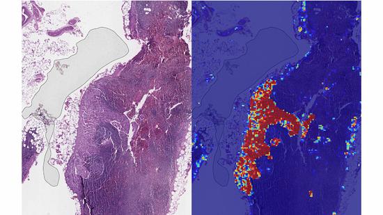 Lymph node tissue from a breast cancer patient, with Google's tool at work on the right. /Photo via Google AI blog