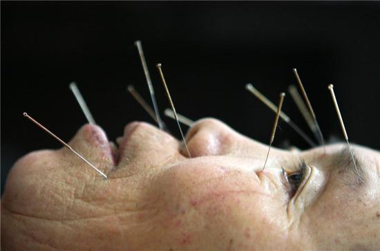 A patient receives acupuncture to treat facial numbness at a clinic of traditional Chinese medicine in Southwest China's Chongqing municipality.  (Photo/China Daily)