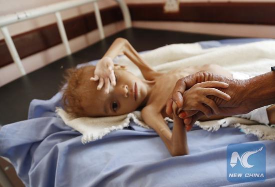A malnourished child is seen at a hospital in Hajjah province, Yemen, Oct. 1, 2018. (Xinhua/Mohammed Mohammed)
