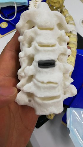 A cervical intervertebral disc produced by a 3D printer. (Photo/Courtesy of Honghui Hospital)