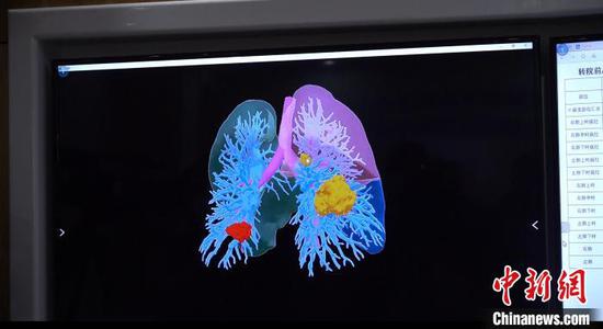 This photo shows a 3D-reconstructed lung model of a newly diagnosed coronavirus pneumonia patient. (Photo: China News Service/Du Xiaoxiao)