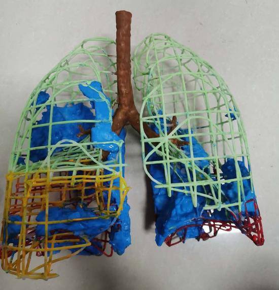 A model shows both lungs of a patient infected with the novel coronavirus. It was made with 3D printing technology at First People's Hospital of Chenzhou in Hunan province. (Photo provided to chinadaily.com.cn)