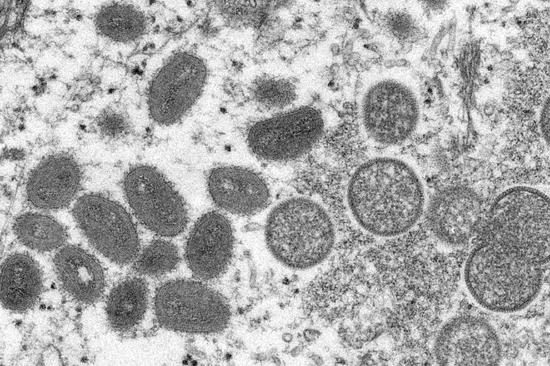 Monkeypox declared Class B infectious disease