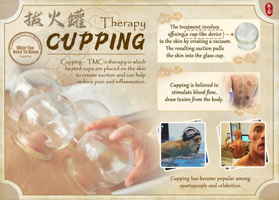 Cupping: What You Need to Know