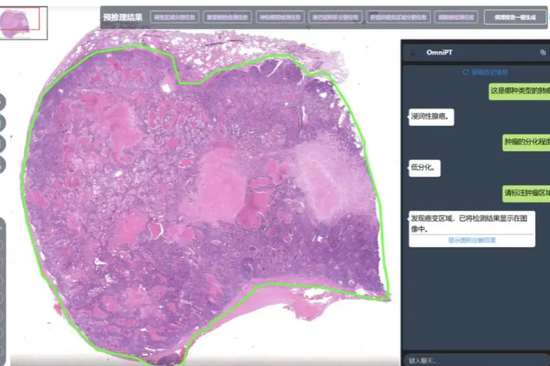 AI assistant gives pathologists helping hand in cancer detection