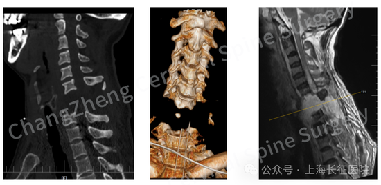Chinese doctors save patient with rare cervical spine injury