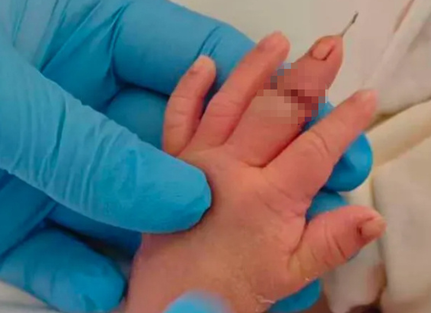 Hospital staff to be held accountable after newborn injured during umbilical cord procedure