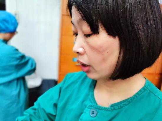 脸颊被口罩勒出深深的印迹. 医院提供