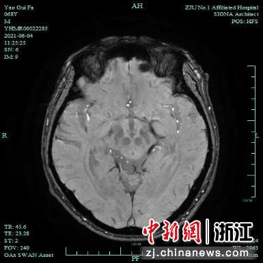 颅脑CT检查结果。 浙大一院供图