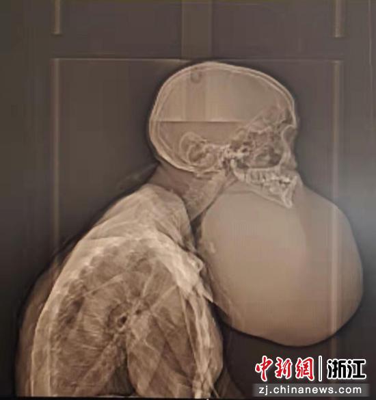 患者侧位片图。 浙江省人民医院 供图