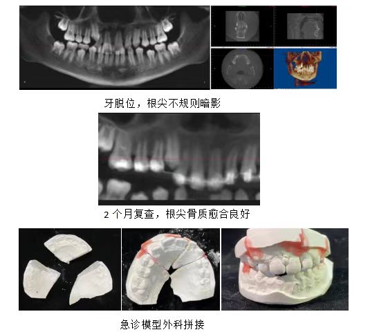 贵州省人民医院多学科合作 治疗八岁儿童颌骨骨折