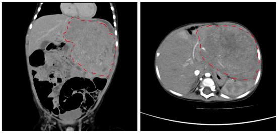 患儿腹部增强CT显示肝左叶巨大占位性病变（红色虚线指示为病灶）