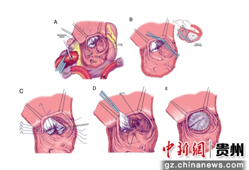 上海儿童医学中心贵州医院成功救治三尖瓣下移畸形患儿