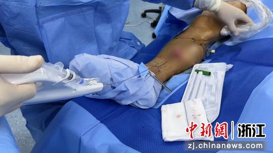 图为手术画面。浙江省人民医院供图 图为手术画面。浙江省人民医院供图