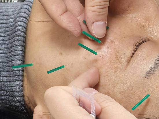 市民接受针灸美容