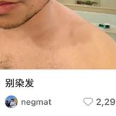 触目惊心！尼格买提晒出染发过敏惨状，这几类人千万别跟风！