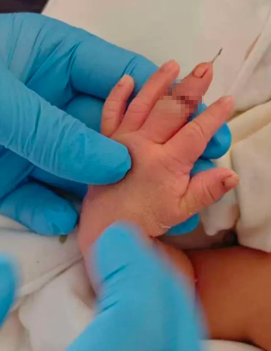 A midwife severs a newborn's middle finger during an umbilical cord procedure