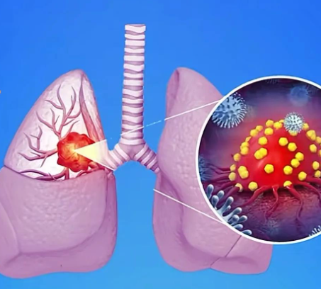Scientists in Australia uncover how lung cancer cells' 'personal lives' predict treatment response
